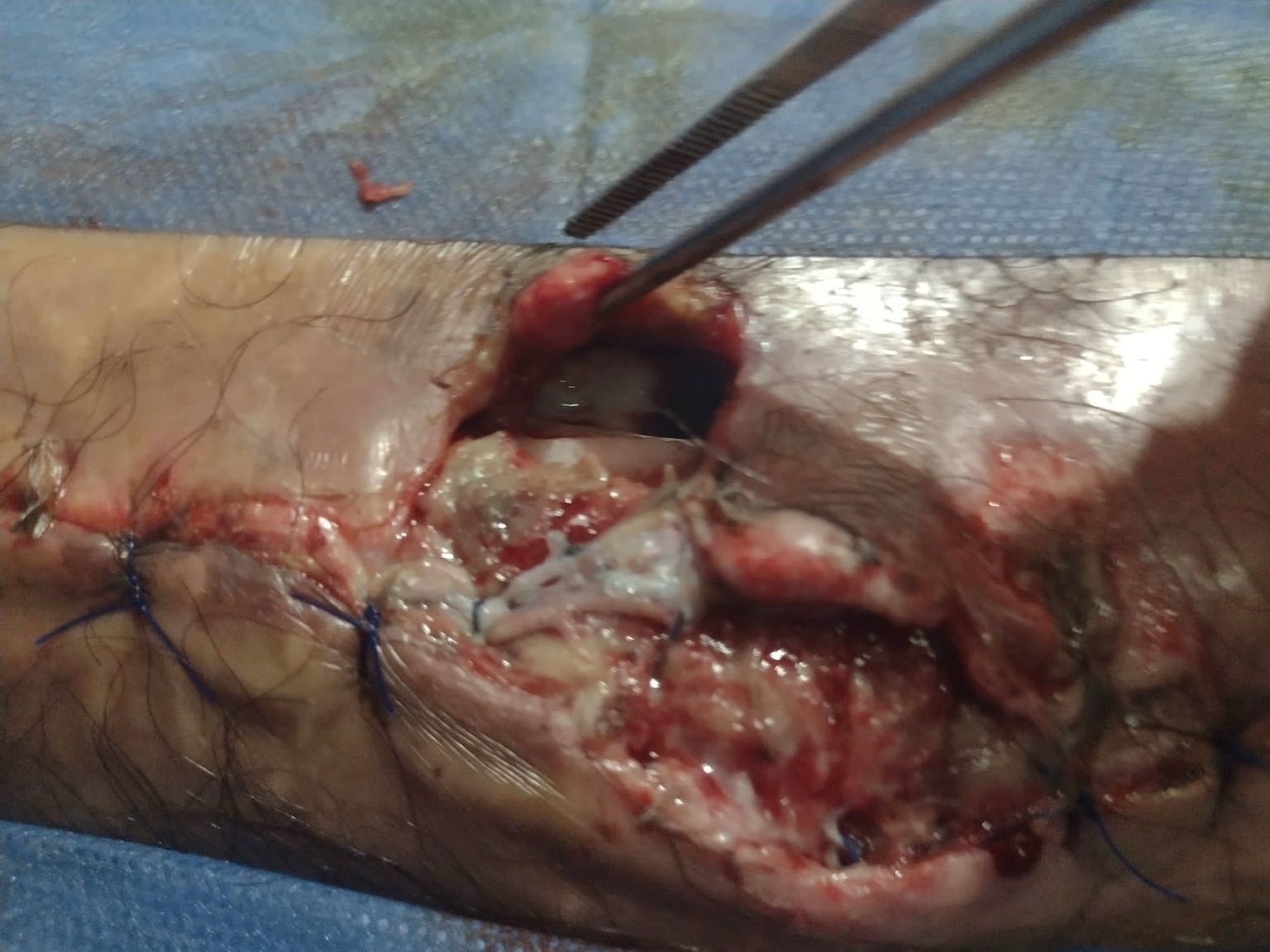 Imagen clínica de herida (2)