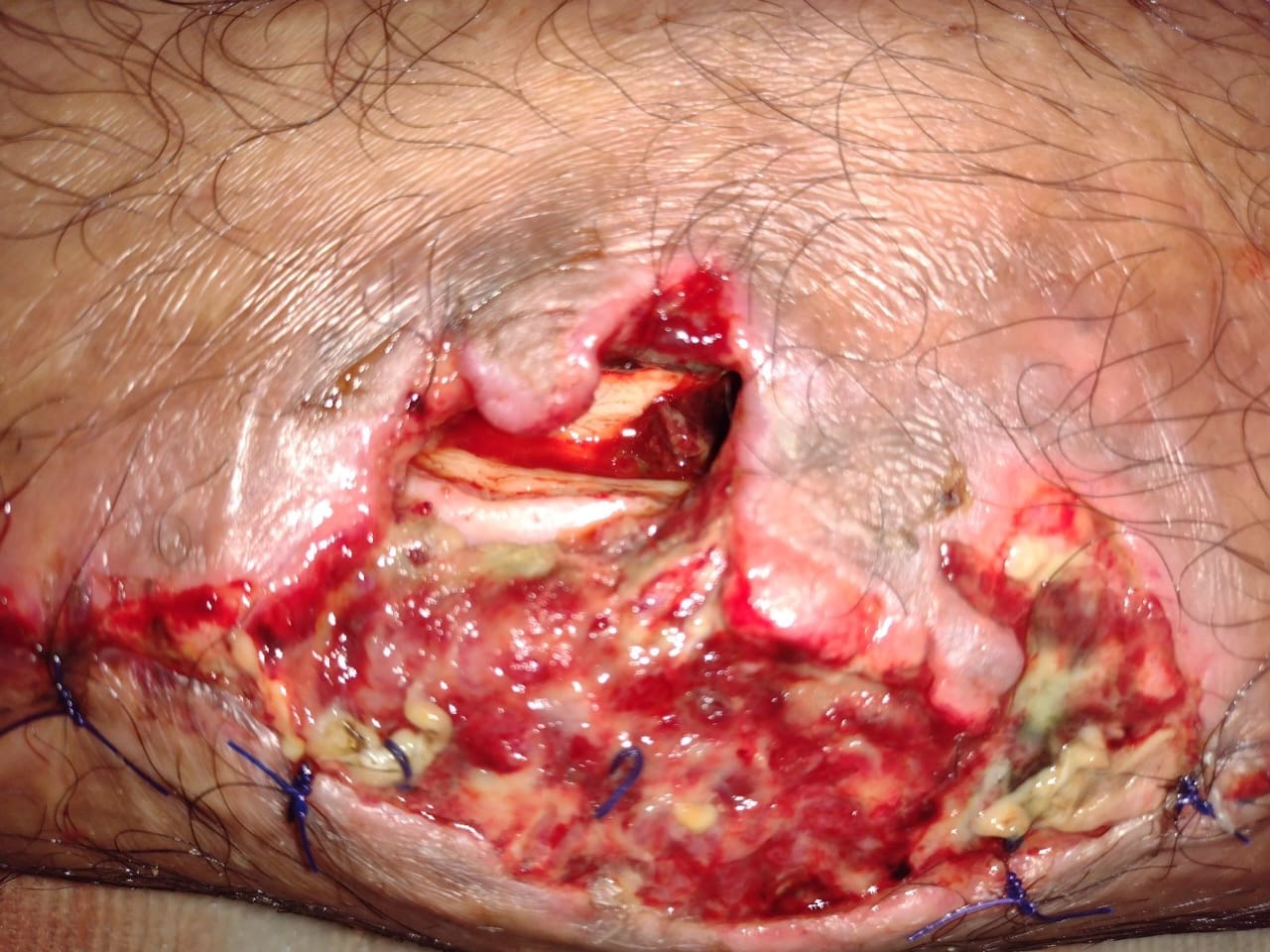 Imagen clínica de herida (3)